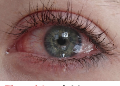 Fibromyalgia and Eye Problems: Why Vision Suffers Beyond Muscles and Joints