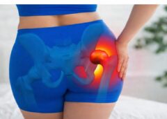 Trochanteric Bursitis in Fibromyalgia: Why Hip Pain Becomes Severe and How to Manage It